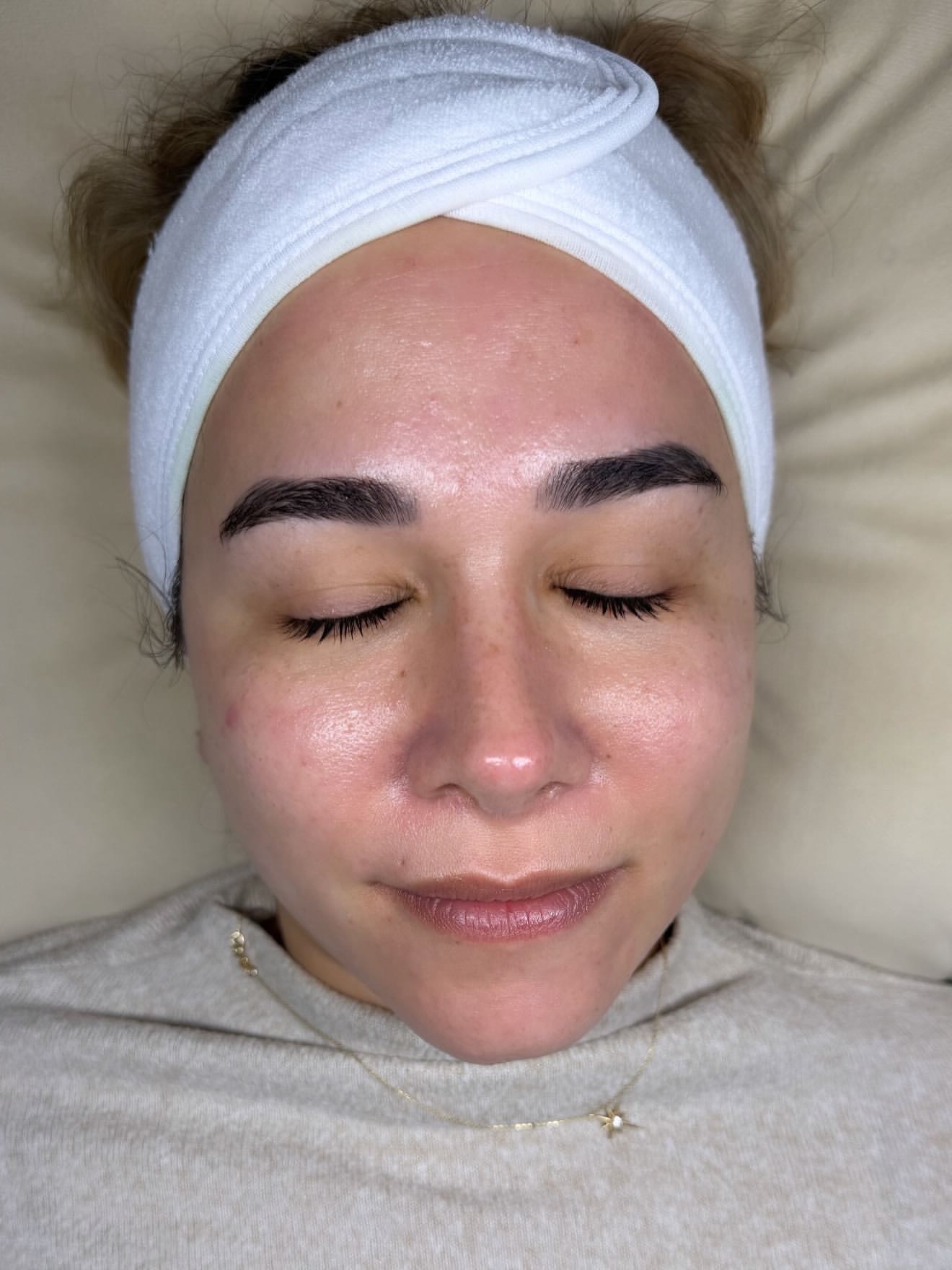 Microneedling · 1 Sitzung – Nachher